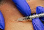 botox injection procedure
