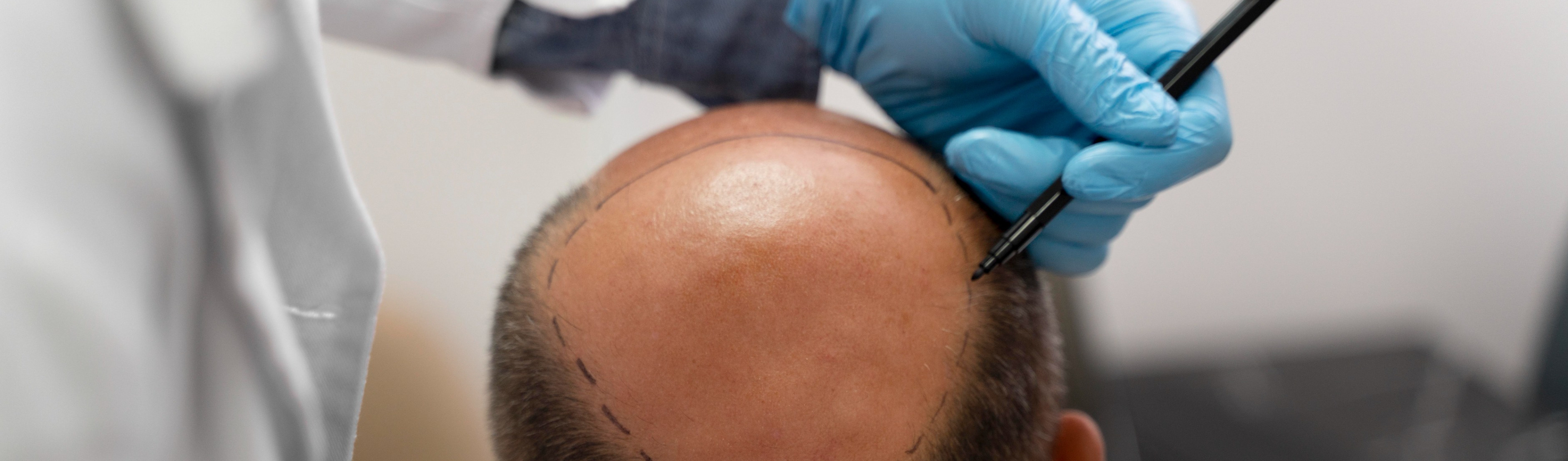 hair restoration treatment before after